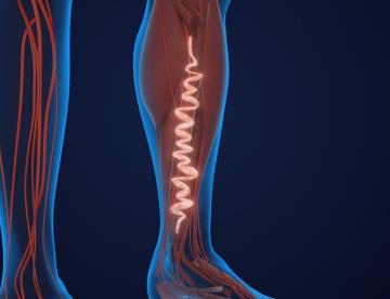 Hinchazón y úlceras en las piernas: Síntomas de Insuficiencia venosa crónica y síndrome postrombótico