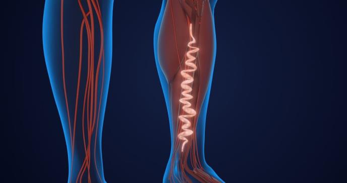 Hinchazón y úlceras en las piernas: Síntomas de Insuficiencia venosa crónica y síndrome postrombótico