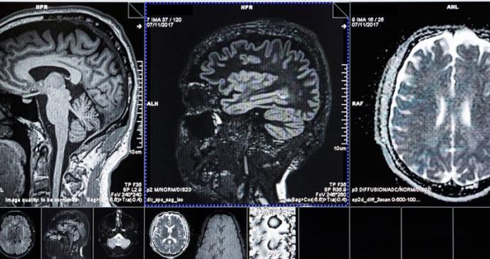 Procedimiento con ultrasonido revierte los síntomas motores del párkinson en ambos hemisferios cerebrales