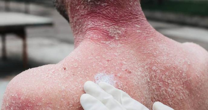 Aumenta el riesgo de eczema en adultos mayores asociado con el uso de antihipertensivos