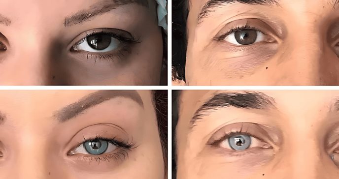 Auge en cirugías para cambiar el color de los ojos preocupa a oftalmólogos por graves complicaciones
