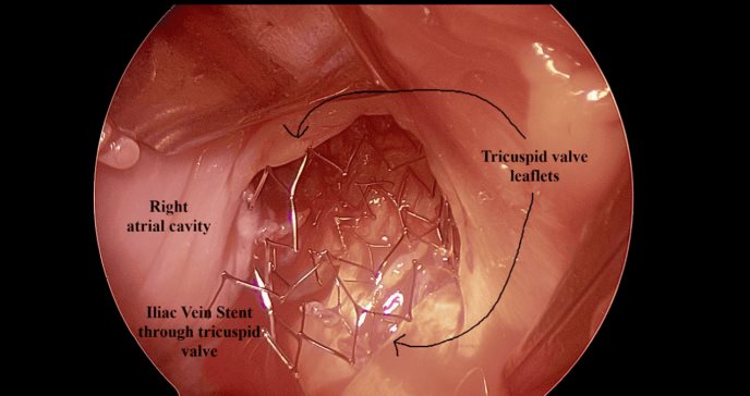 Paciente con antecedente de May-Thurner es intervenida por obstrucción de la vena ilíaca con stent