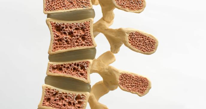 Proteína podría prevenir la pérdida excesiva de hueso en osteoporosis