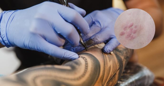 ¿Por qué los tatuajes pueden ser un factor de riesgo para el desarrollo de un linfoma?  