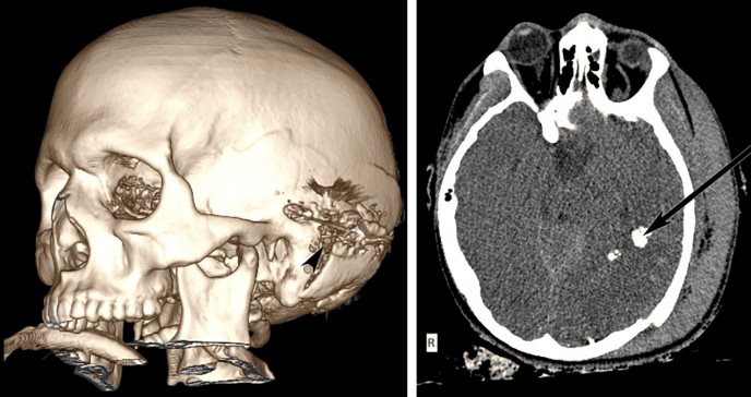 Craniectomía descompresiva y evolución neurológica luego de traumatismo craneoencefálico por herida de bala
